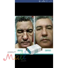 تجميل حصري بالخلايا الجذعيه